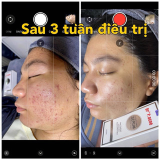 SERUM MỤN DR P.ACNE