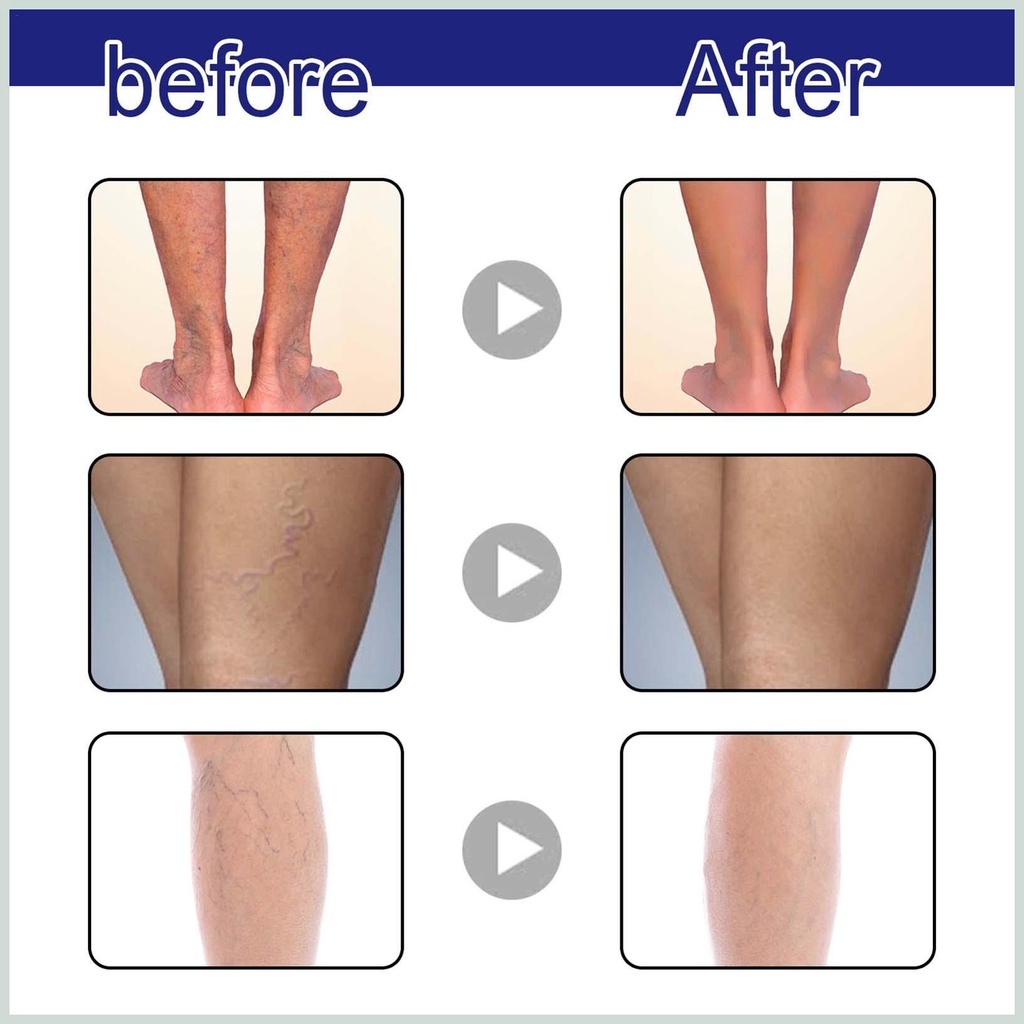 Tinh Chất Thảo Dược Suy Giãn Tĩnh Mạch Varicose Vein Spray 30ml - Xịt Cải Thiện Lưu Thông Hết Suy Giãn Tĩnh Mạch