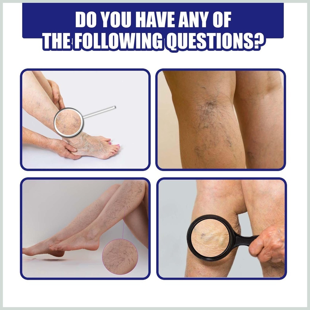 Tinh Chất Thảo Dược Suy Giãn Tĩnh Mạch Varicose Vein Spray 30ml - Xịt Cải Thiện Lưu Thông Hết Suy Giãn Tĩnh Mạch