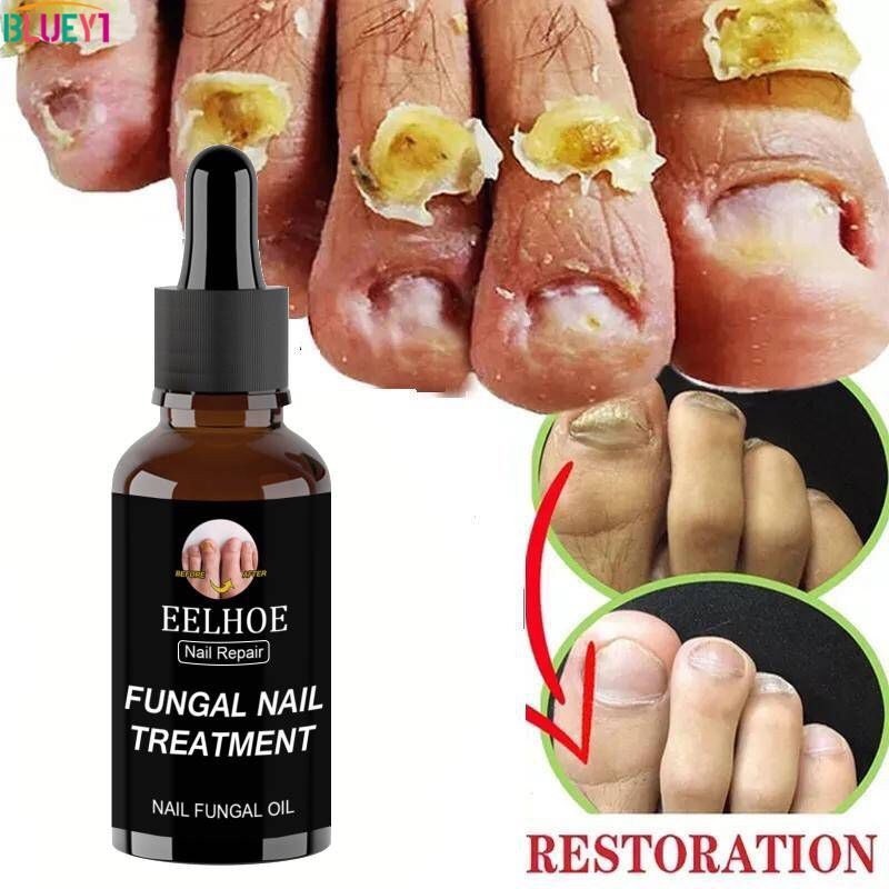 Serum Nấm Móng Thảo Dược Eelhoe Hoa Kì - Tinh Chất Dưỡng Móng Phục Hồi Mô Móng Eelhoe