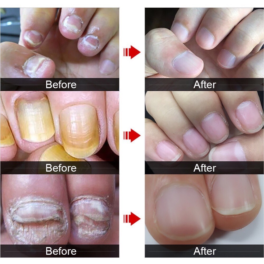 Serum Nấm Móng Thảo Dược Eelhoe Hoa Kì - Tinh Chất Dưỡng Móng Phục Hồi Mô Móng Eelhoe