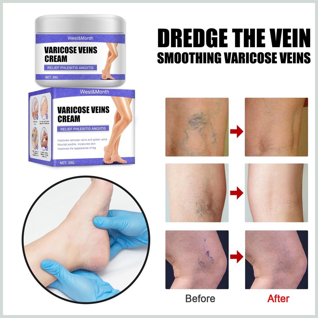 Kem Thảo Dược Varicose Veins Cream - Kem Bôi Cải Thiện Suy Giãn Tĩnh Mạch Làm Dịu Hỗ Trợ Lưu Thông Mao Mạch