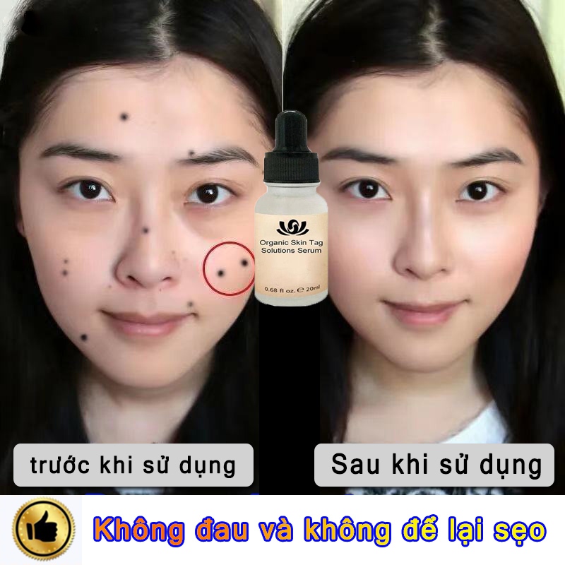 tẩy nốt ruồi chấm nốt ruồi Loại Bỏ Vết Đốm Đốm Đen Tàn Nhang loại bỏ mụn cóc ở da,Độ Làm Đẹp Da phục hồi da và làm sạch