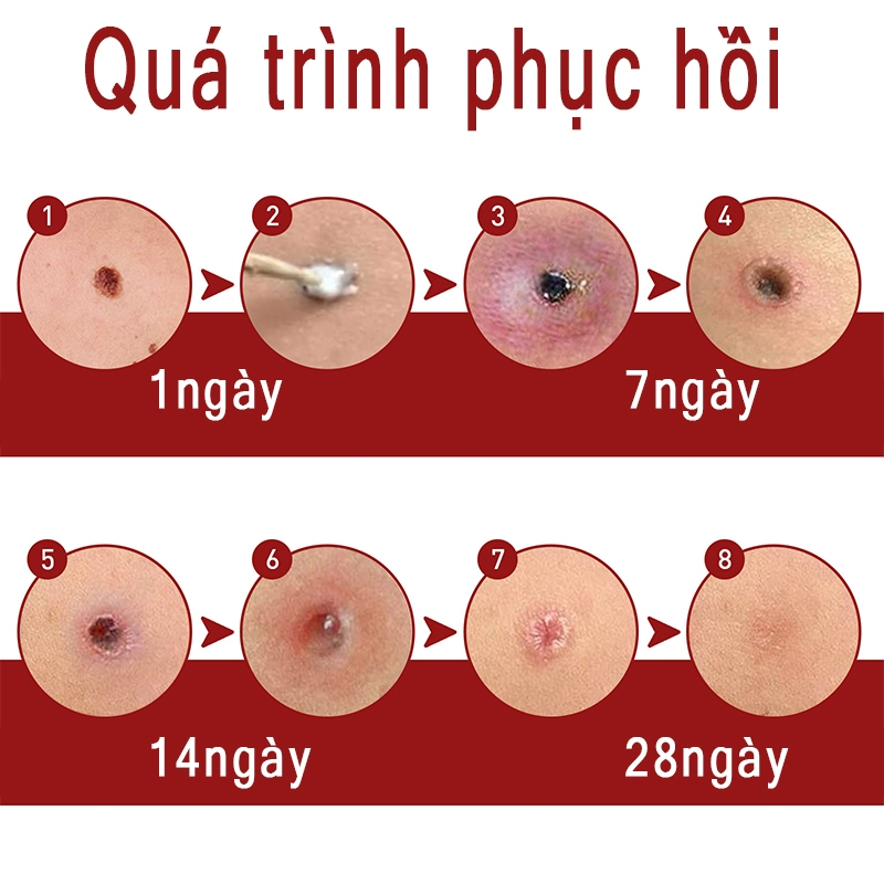 tẩy nốt ruồi chấm nốt ruồi Loại Bỏ Vết Đốm Đốm Đen Tàn Nhang loại bỏ mụn cóc ở da,Độ Làm Đẹp Da phục hồi da và làm sạch