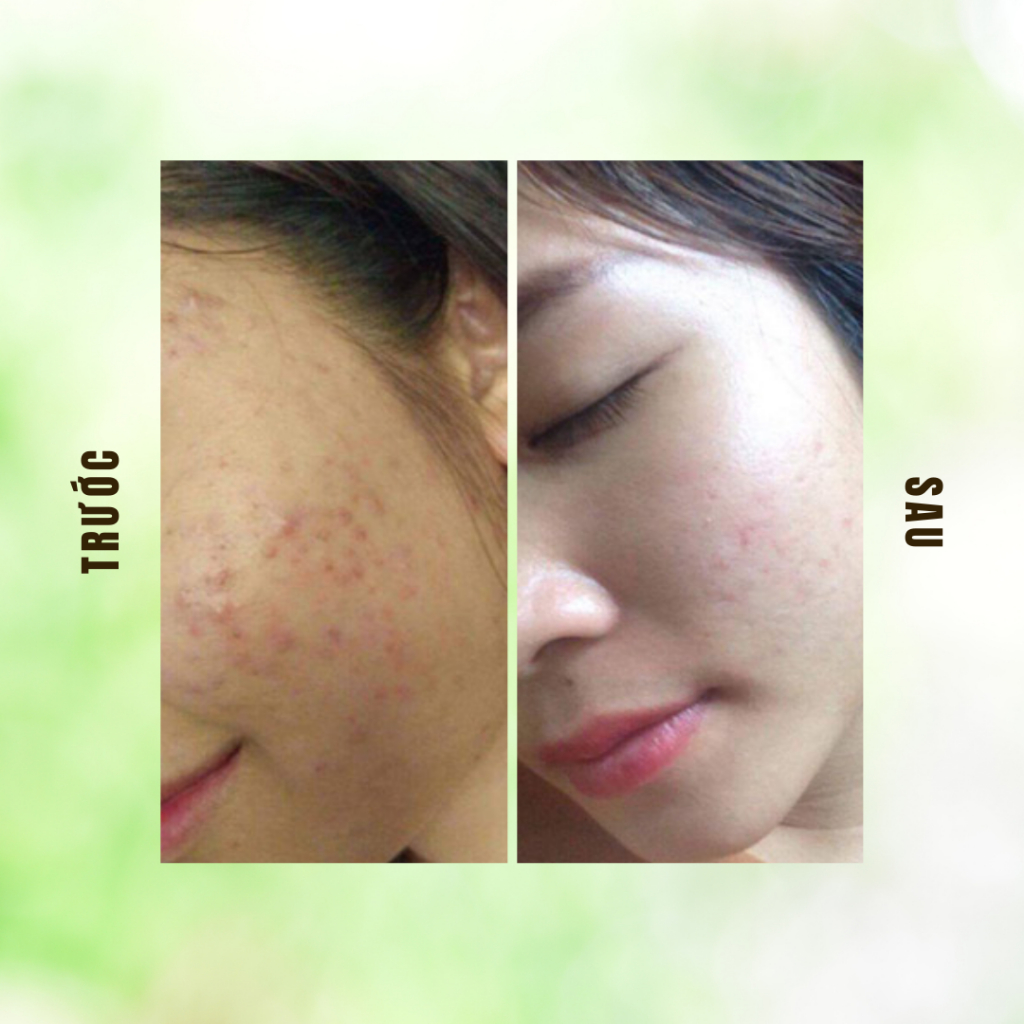 Tinh Chất Dưỡng Da Sắc Mộc Thiên - Tái Tạo Da, Se Khít Lỗ Chân Lông, Sáng Da| Moska Shop