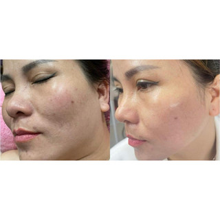 Tinh Chất Serum VitaminC 561 Esthemax