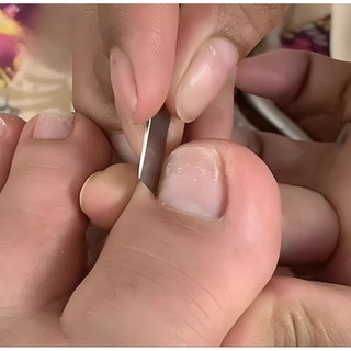 Bộ Dao lấy khoé , cắt khóe