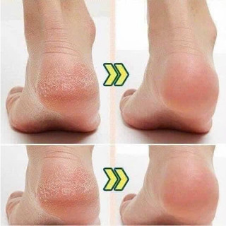 Kem Nứt Gót Kpem