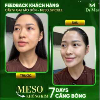Meso căng bóng Dr Mai sale ( giá gốc 480k)