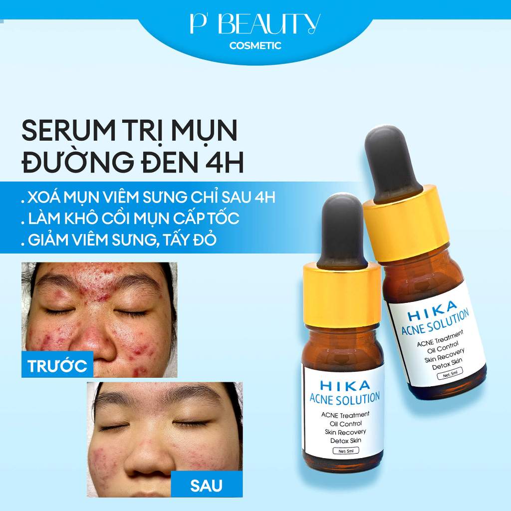 Serum MỤN 4h đường đen Hika Acne Treatment Oil Control Skin Recovery Detox Skin P Beauty Offical