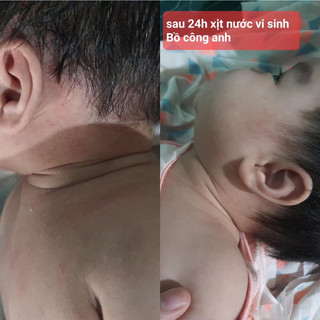 Vi sinh bồ công anh