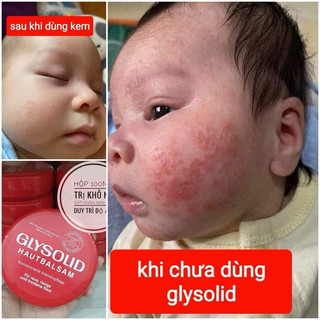 KEM ĐA NĂNG GLYSOLID CHO DA NỨT NẺ, DA CHÀM, 100ML
