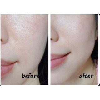 PEPTIDE SE LỖ CHÂN LÔNG