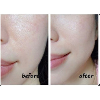 PEPTIDE SE LỖ CHÂN LÔNG