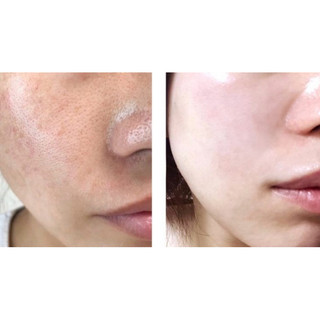 PEPTIDE SE LỖ CHÂN LÔNG