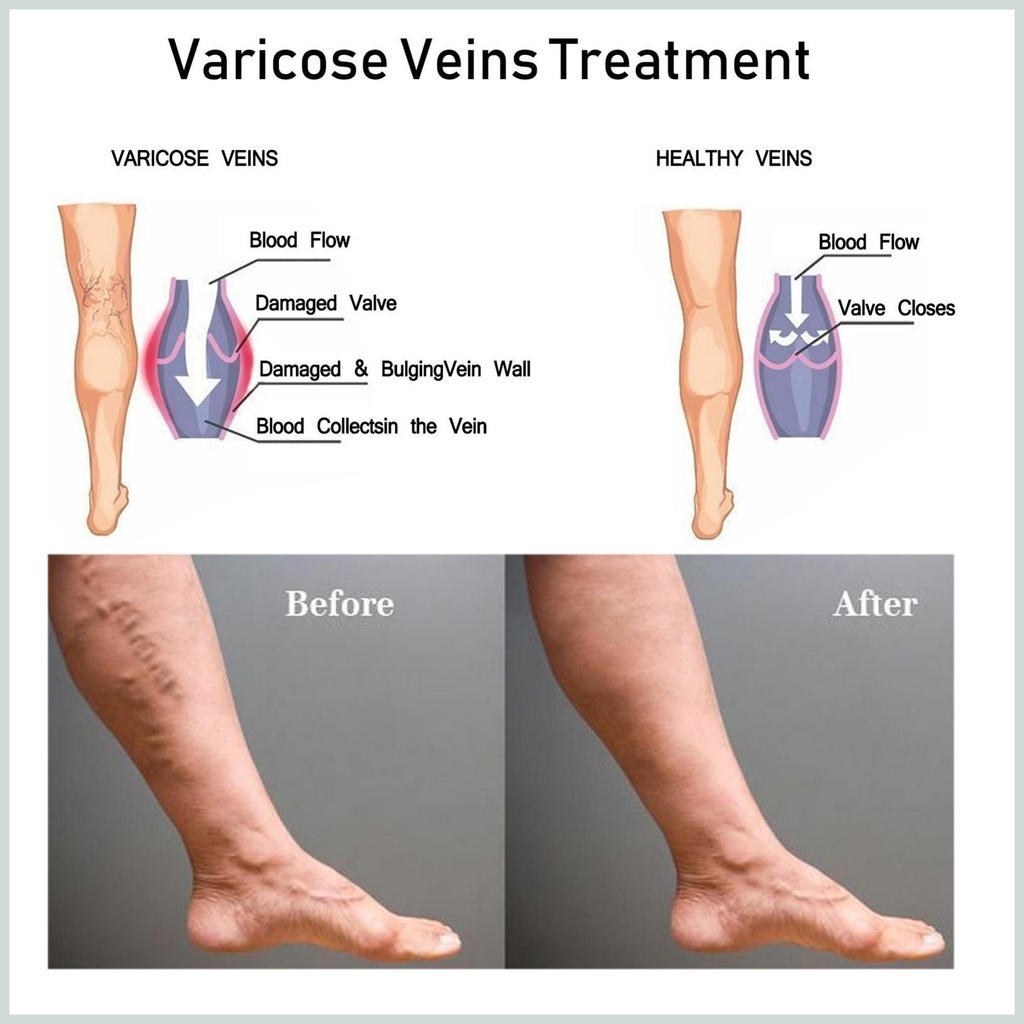 Kem Cải Thiện Tĩnh Mạch Varicose Vein Repair Cream 50g - Kem Dưỡng Da, Phục Hồi Tĩnh Mạch Perfect Skin