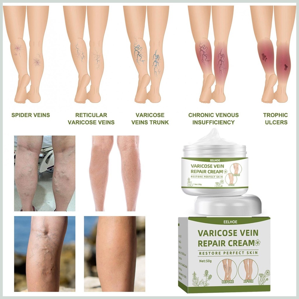 Kem Cải Thiện Tĩnh Mạch Varicose Vein Repair Cream 50g - Kem Dưỡng Da, Phục Hồi Tĩnh Mạch Perfect Skin