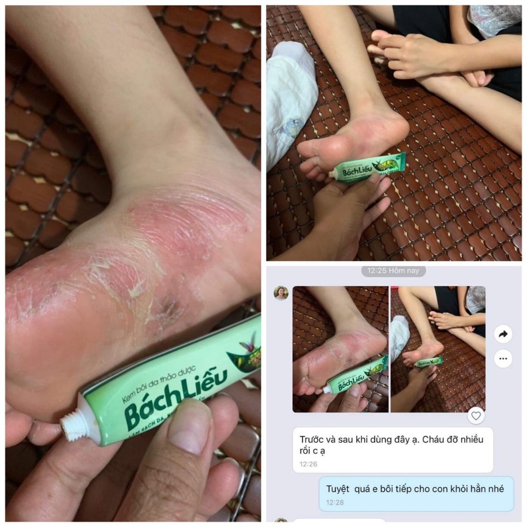 Kem Bôi Da Thảo Dược Bách Liễu SLIMMING CARE - Dùng Cho: Viêm, Nấm, Ngứa, Á S.ừng, Hăm, Mẩn ngứa