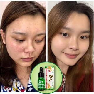 Serum Mụn 3M