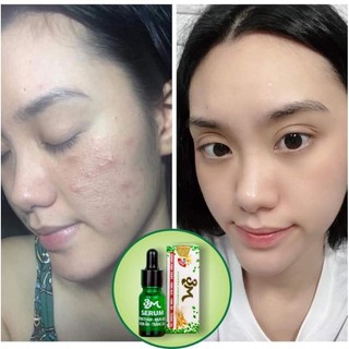 Serum Mụn 3M