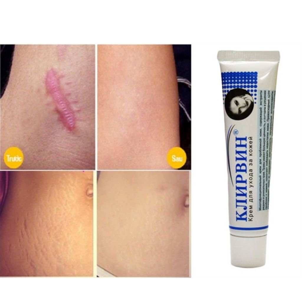 Kem mờ sẹo KLIRVIN, mờ thâm, sẹo lồi, sẹo lõm, sẹo do mụn 25g