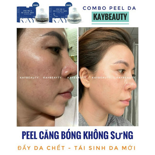 KEM PIU BONG DA CĂNG BÓNG ( tặng phục hồi)