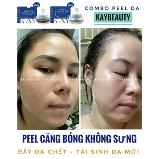 KEM PIU BONG DA CĂNG BÓNG ( tặng phục hồi)
