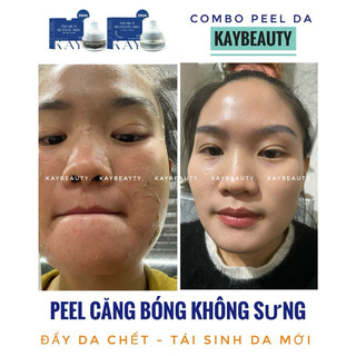 KEM PIU BONG DA CĂNG BÓNG ( tặng phục hồi)
