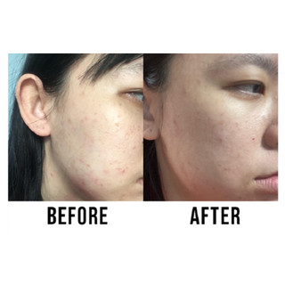 [HÀNG TẶNG KHÔNG BÁN][HSD 30/10/2025] Sữa Rửa Mặt Neem (Ngừa Mụn Trứng Cá) 100ML