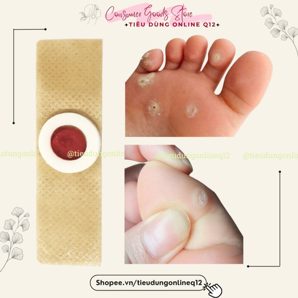Miếng dán mụn cóc, mụn nhọt, mụn cơm, vết chai - Lẻ 1 miếng