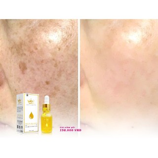 Serum nám melasma pháp cosmetics [chính hãng]