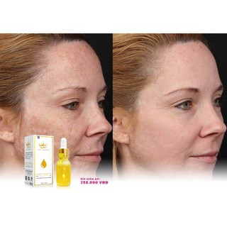 Serum nám melasma pháp cosmetics [chính hãng]