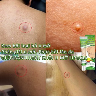 Kem bôi u mỡ Kem tan mỡ Kem bôi loại bỏ u mỡ Kem đốt mỡ Phân giải u mỡ, Phục hồi làn da,Phân giải hoặc loại bỏ khối u mỡ