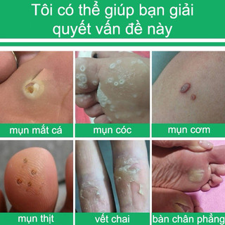 Tẩy nốt ruồi ,Xóa mụn cóc, mụn thịt, mắt cá chân,mụn cơm N-Cosmetic