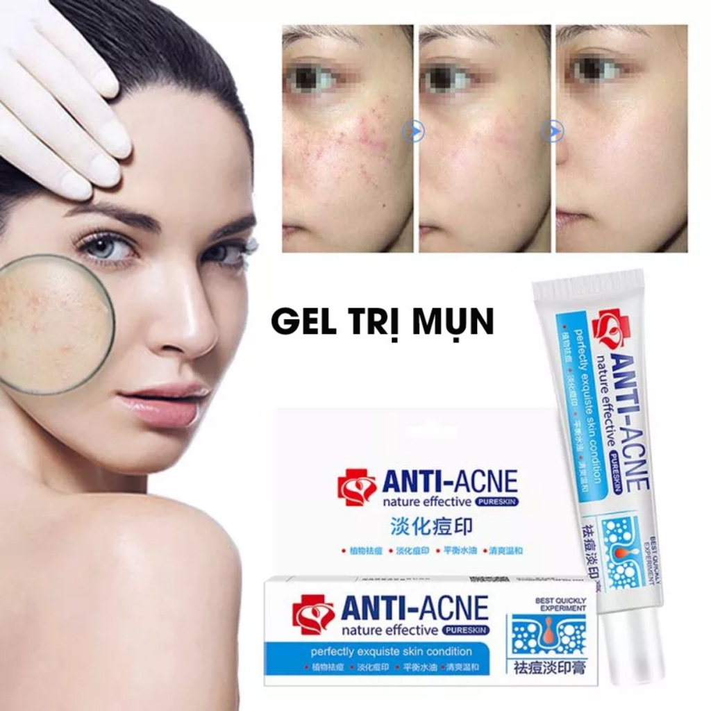 Kem Xóa Sẹo Rỗ Anti Acne 25g - Gel Anti Acne Loại Bỏ Sẹo Rỗ, Sẹo Lõm, Phục Hồi Vùng Da Bị Sẹo, Mờ Thâm Sáng Da