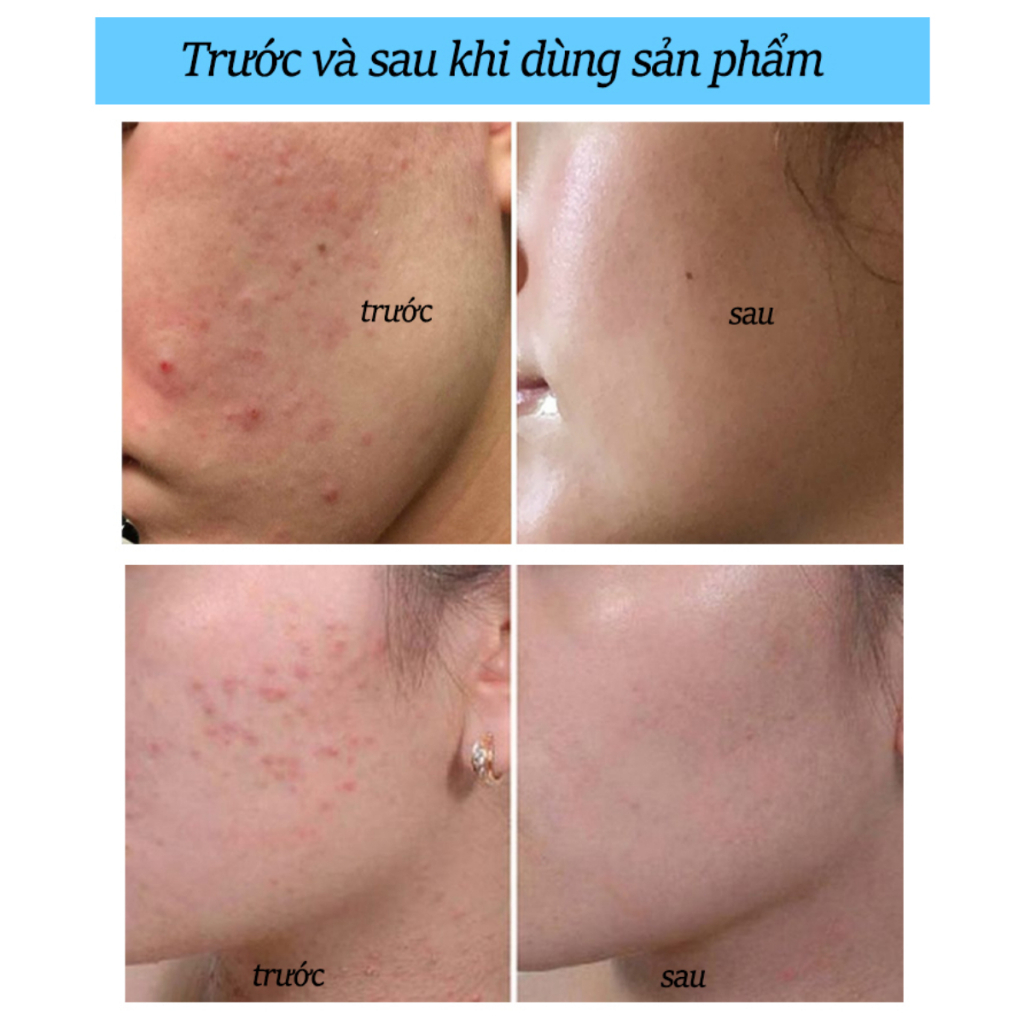 Kem Xóa Sẹo Rỗ Anti Acne 25g - Gel Anti Acne Loại Bỏ Sẹo Rỗ, Sẹo Lõm, Phục Hồi Vùng Da Bị Sẹo, Mờ Thâm Sáng Da