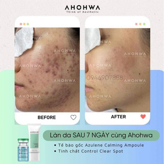 TINH CHẤT CHẤM MỤN AHOHAW