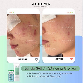TINH CHẤT CHẤM MỤN AHOHAW