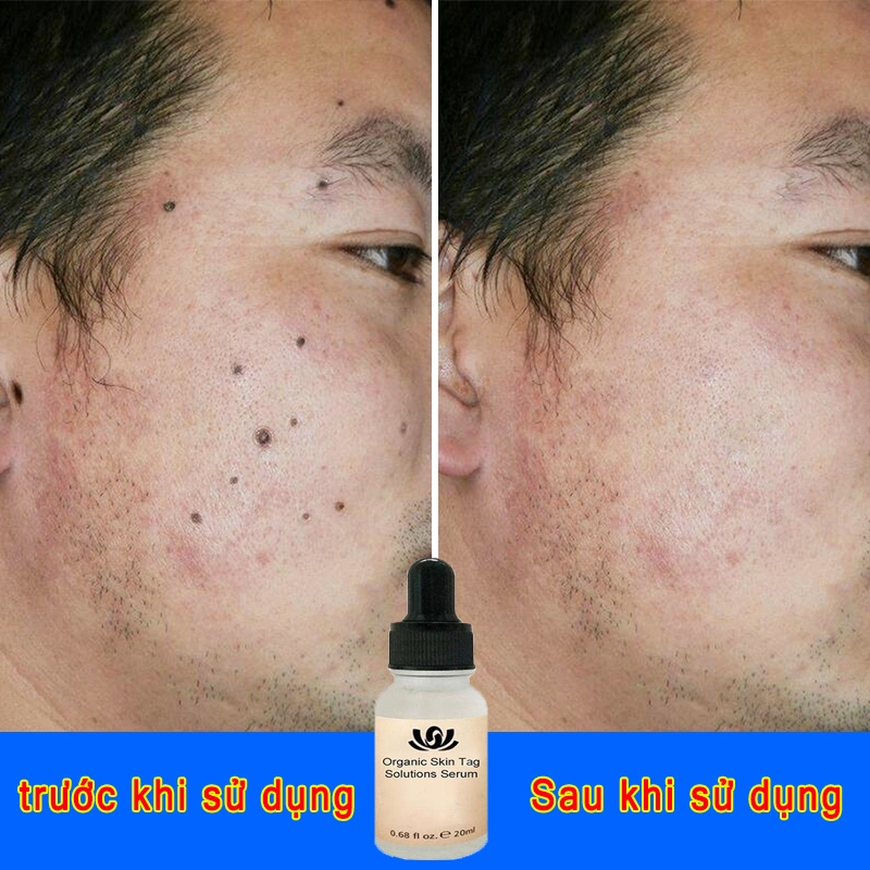 tẩy nốt ruồi chấm nốt ruồi Loại Bỏ Vết Đốm Đốm Đen Tàn Nhang loại bỏ mụn cóc ở da,Độ Làm Đẹp Da phục hồi da và làm sạch