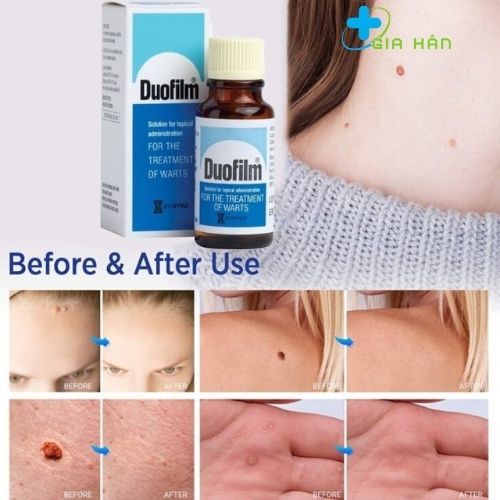 Loại bỏ mụn cóc, chai chân, mụn cơm Duofilm 15ml.
