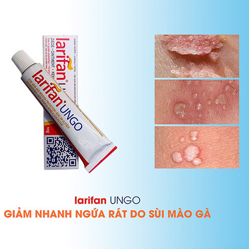 Kem bôi Larifan Ungo ngăn ngừa mụn rộp, sùi mào gà, Herpes 10g xuất xứ Châu Âu.