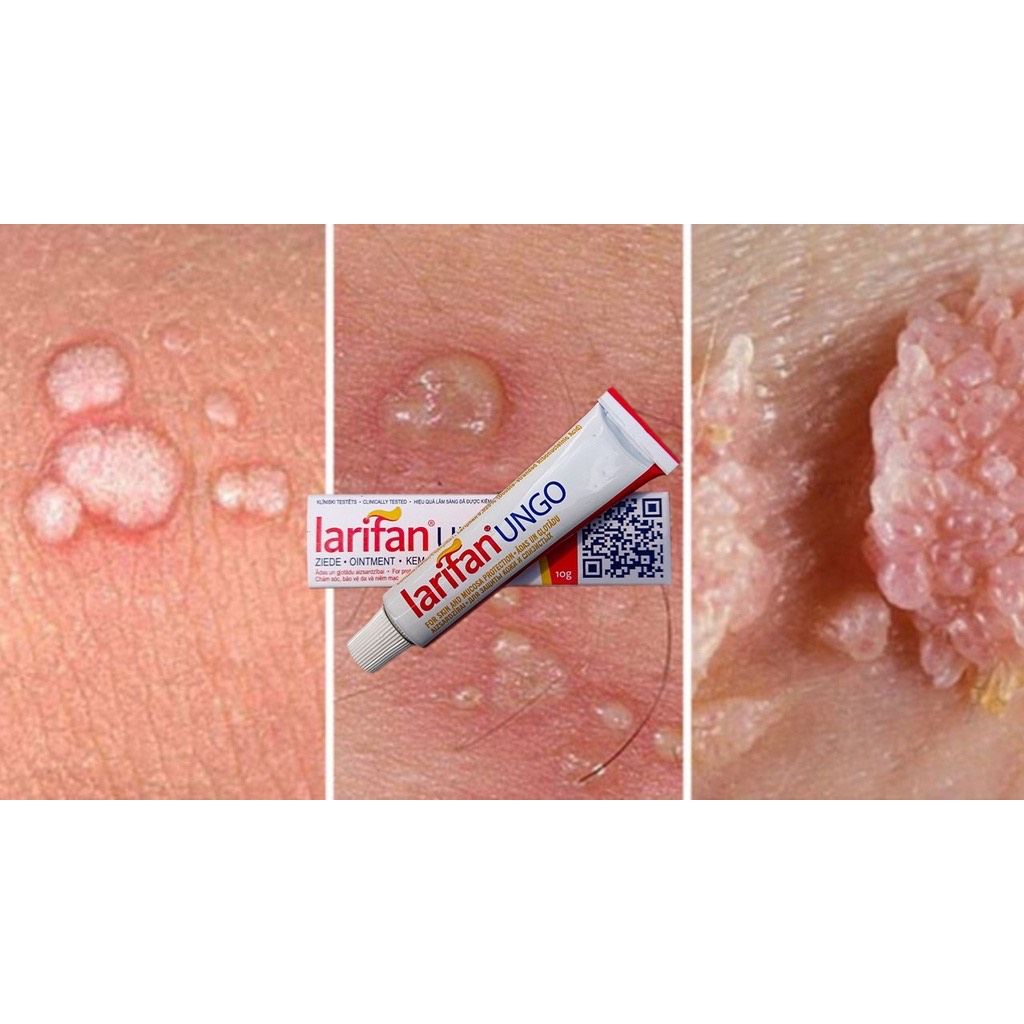 Kem bôi Larifan Ungo ngăn ngừa mụn rộp, sùi mào gà, Herpes 10g xuất xứ Châu Âu.