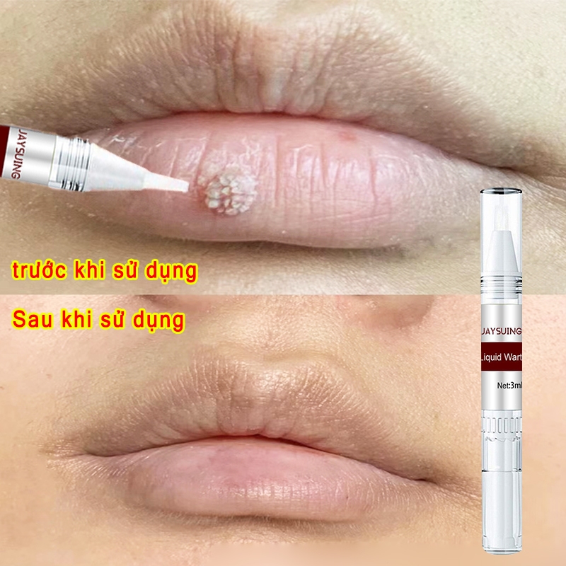 Kem Tẩy Nốt Ruồi Loại Bỏ Mụn Cóc, Mụn Cơm, Mụn Thịt, Mụn Cóc Jaysuing - Kem Jaysuing Sạch Mụn Thịt Dư Không Sẹo Tại Nhà