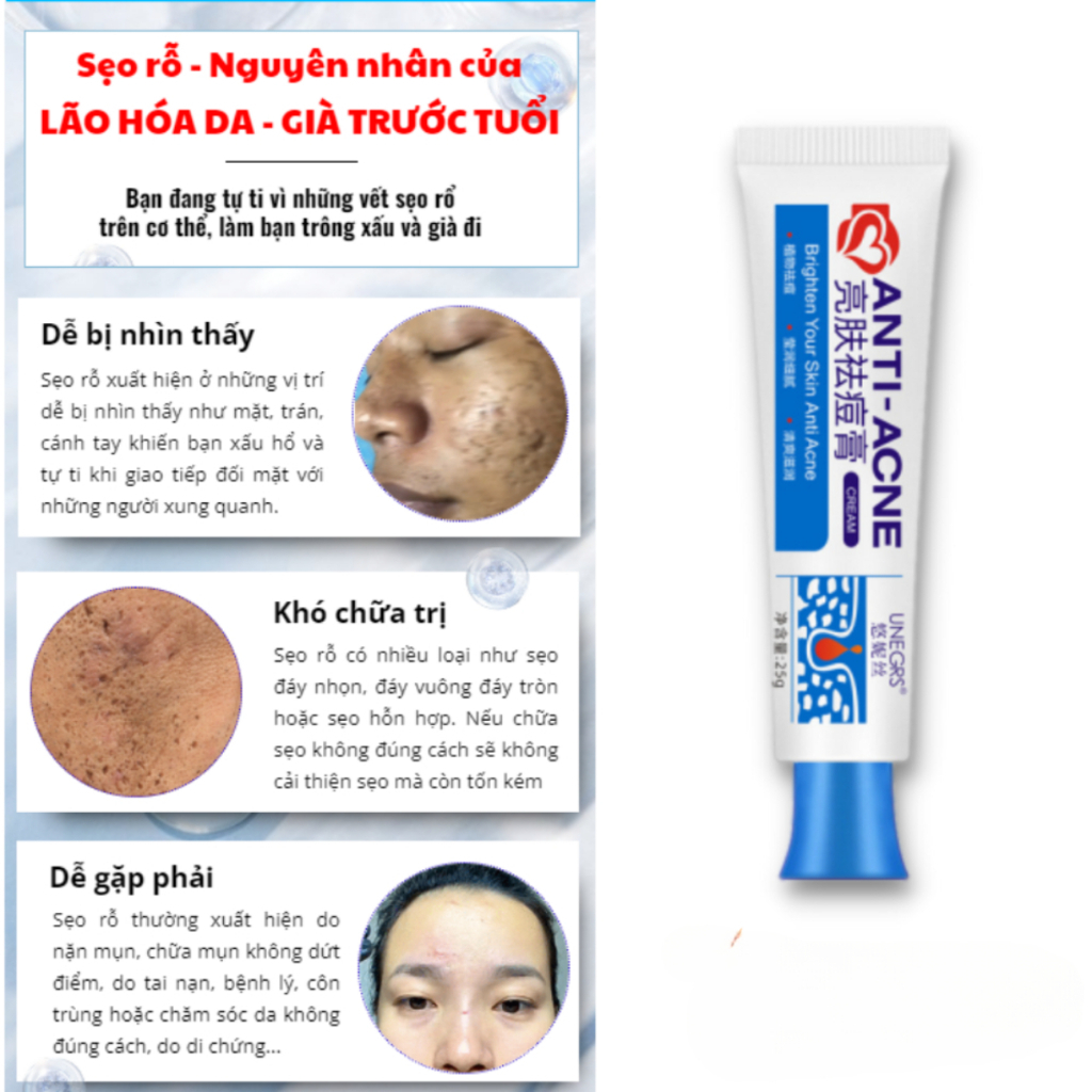 Kem Xoá Sẹo Rỗ Thảo Dược Anti - Acne, Kem Anti Acne Lành Sẹo Rỗ, Sẹo Lõm, Giúp Lấy Lại Làn Da Khoẻ Mạnh