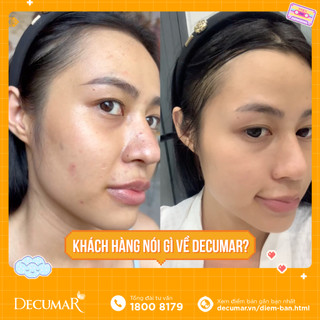 [Hàng tặng không bán] Bộ đôi ngừa mụn, thâm, sẹo Decumar THC - HN0574