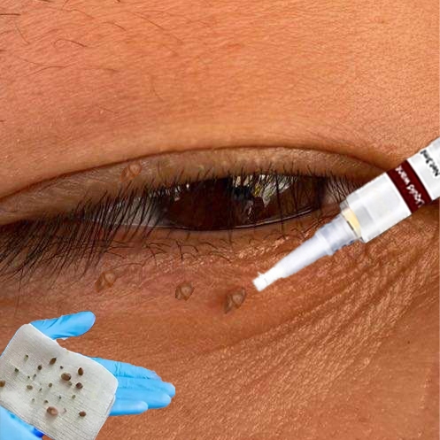 Bút Chấm Mụn Thịt, Tẩy Nốt Ruồi, Xóa Tàn Nhang, thành phần thảo dược 100% an toàn và không đau rát