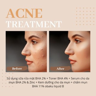Serum Giảm Mụn, Thu Nhỏ Lỗ Chân Lông Herbal Stories 20ml