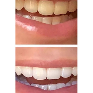 [HOẢ TỐC] Linary1994 - Miếng dán trắng răng Crest 3D White 🇺🇸