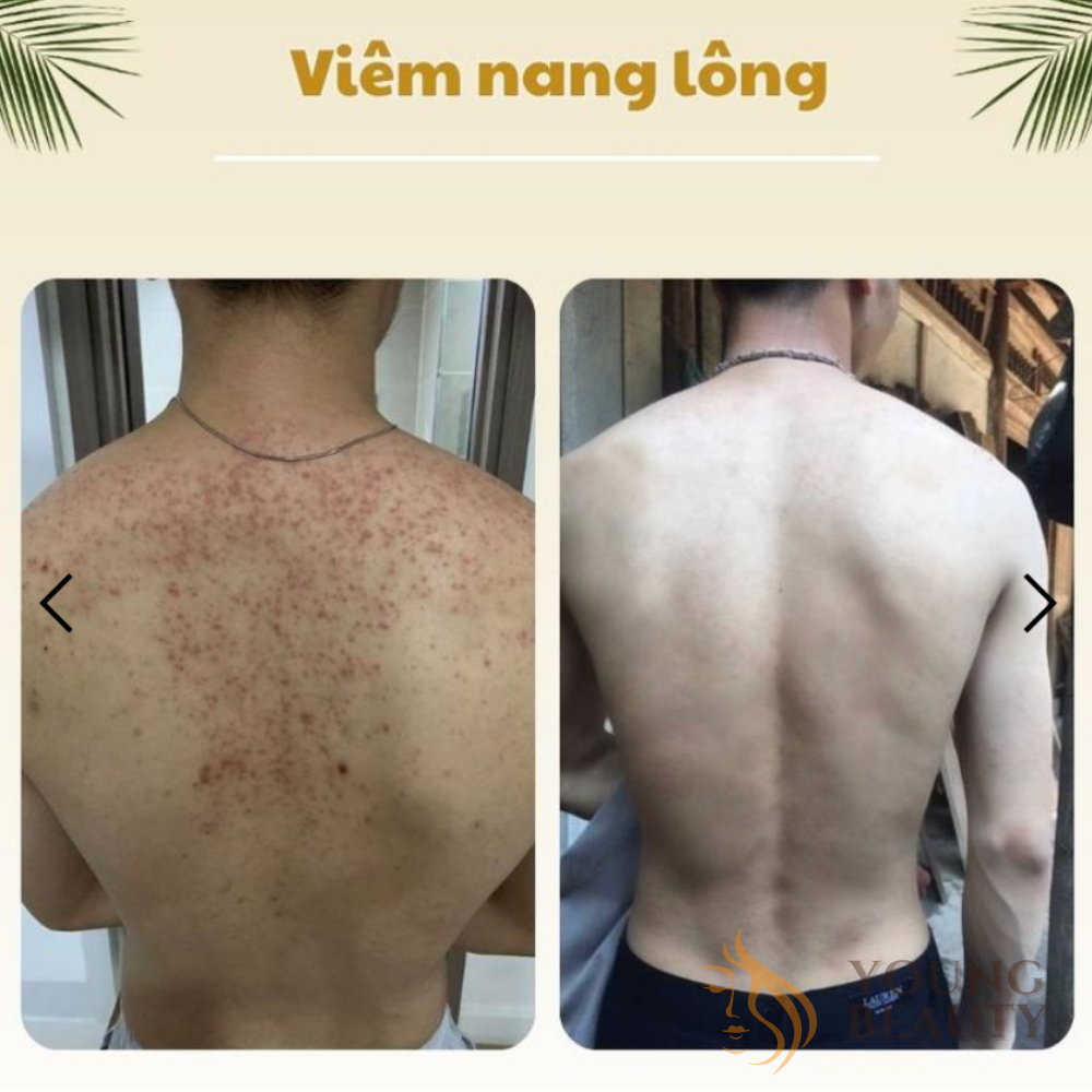 Tinh chất tắm dược liệu CLEAN, Chặn mụn ngăn thâm, Không lo tái phát, Dung tích 500ml - YOUNG BEAUTY