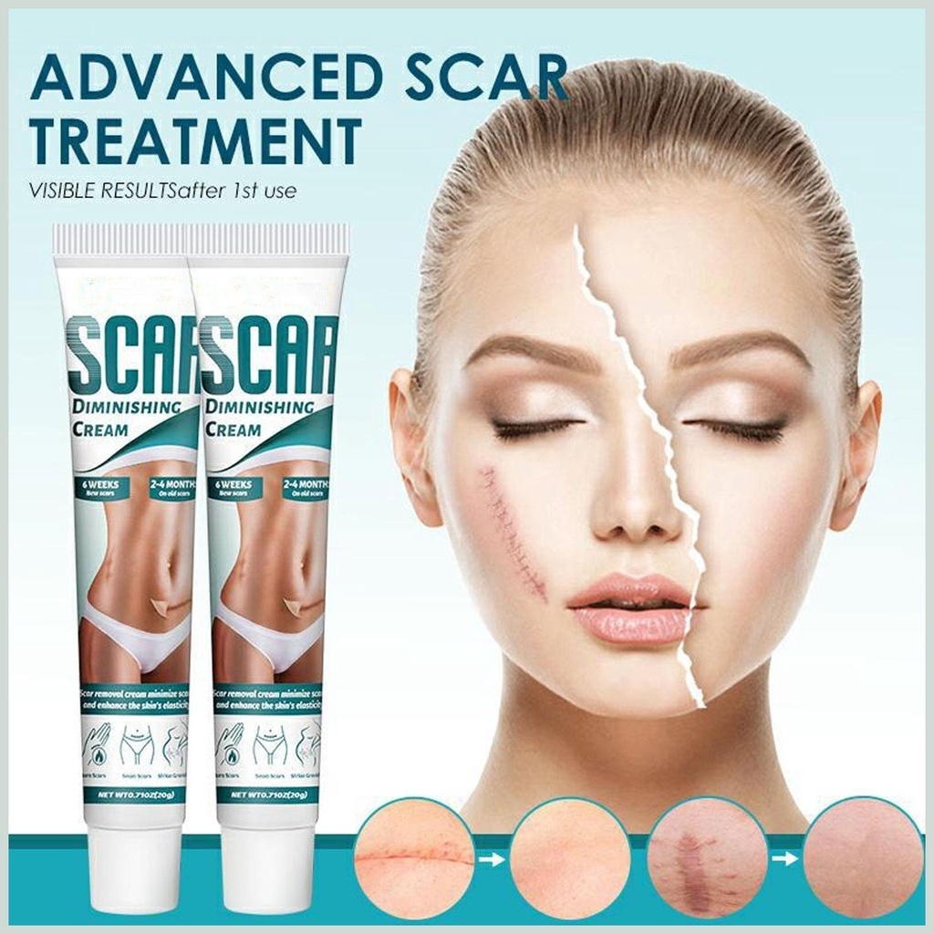 Kem Phẳng Mờ Sẹo Rạn Da Scar Diminishing Cream - Kem Dưỡng Ẩm Giảm Vết Rạn Da Mờ Sẹo Giúp Da Tăng Sự Đàn Hồi Da